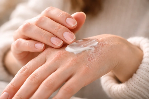 درمان خشکی دست در سرما